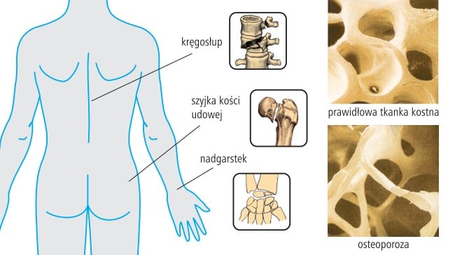 Profilaktyka osteoporozy w Zbąszynku Radio Zachód - Lubuskie