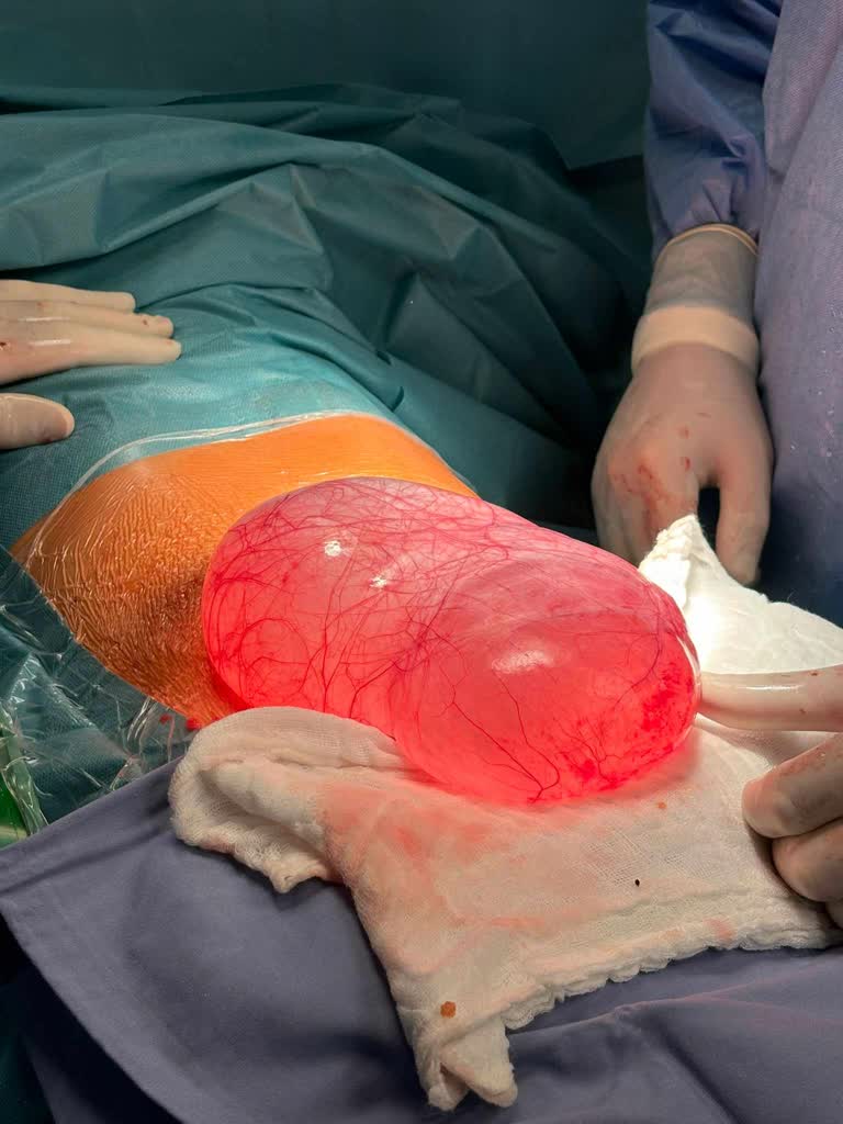 Gorzowscy lekarze wycięli z brzucha nastolatki 3,5 kg torbiel Radio Zachód - Lubuskie